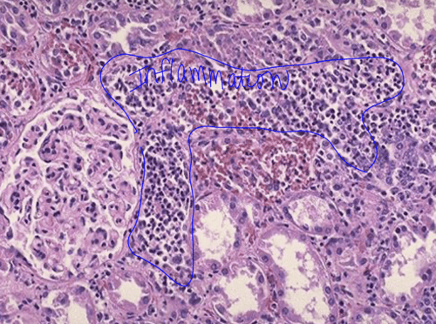 <p>necrotizing papillitis (papillary necrosis)</p>