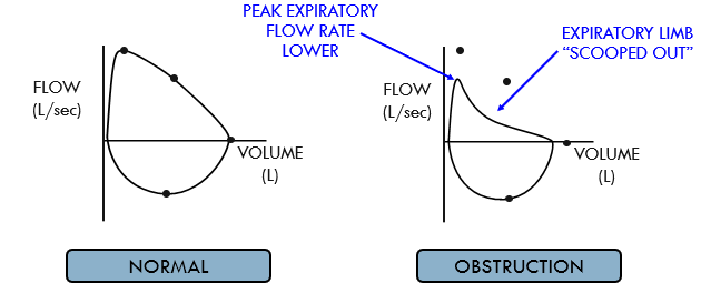 <p>inspiratory limb looks normal </p><p>peak expiratory flow is lower (indicated lung funx is worse) </p><p>scooped out shape due to differential emptying of lung units </p>