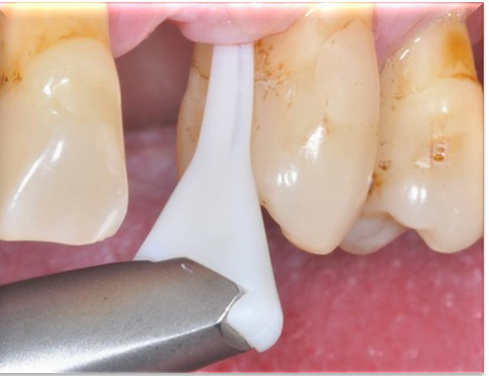 <p>What is the purpose of subgingival air polishing?</p>