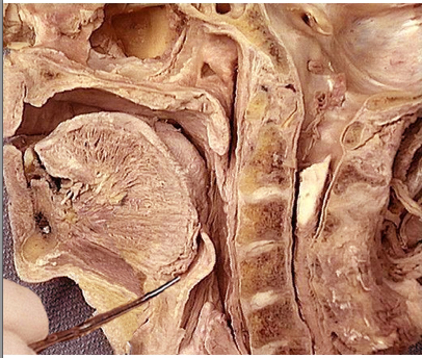 <p>depression between the epiglottis and the base of the tongue.</p><p>- Target of blade for intubation</p>