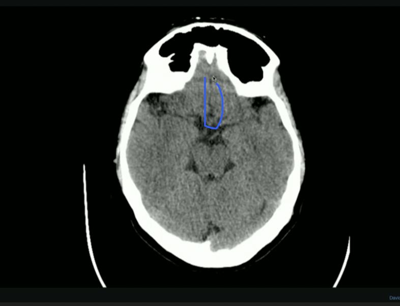<p>What Fissure is this?</p>