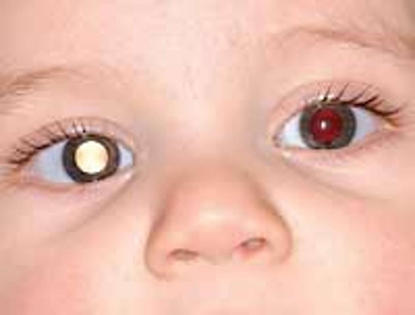 <p>retinoblastoma --&gt; 2/3 are unilateral</p><p>always eval siblings if + dx!</p>