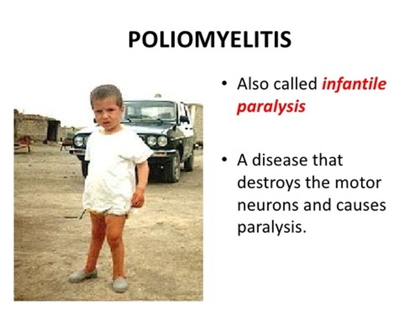 <p>polio</p>