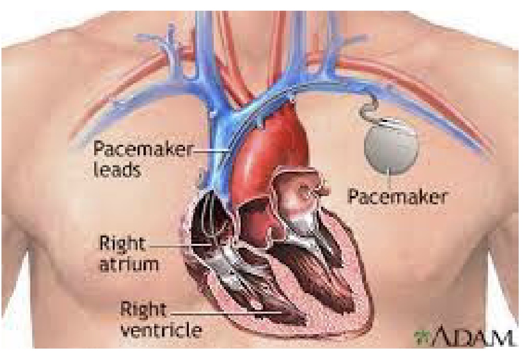 <p>-if have a primary arrhythmia</p><p>-generates cardiac rhythm for the heart</p><p>-exercise Rx depends on pacemaker</p><p>1) what is the HR response?</p><p>2) don’t want to damage the pacemakers</p>