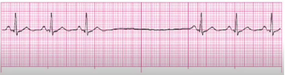 <p>tx if symptomatic</p><p>stop meds that cause it</p><p>IV atropine if too slow</p><p>pacer if chronic</p>