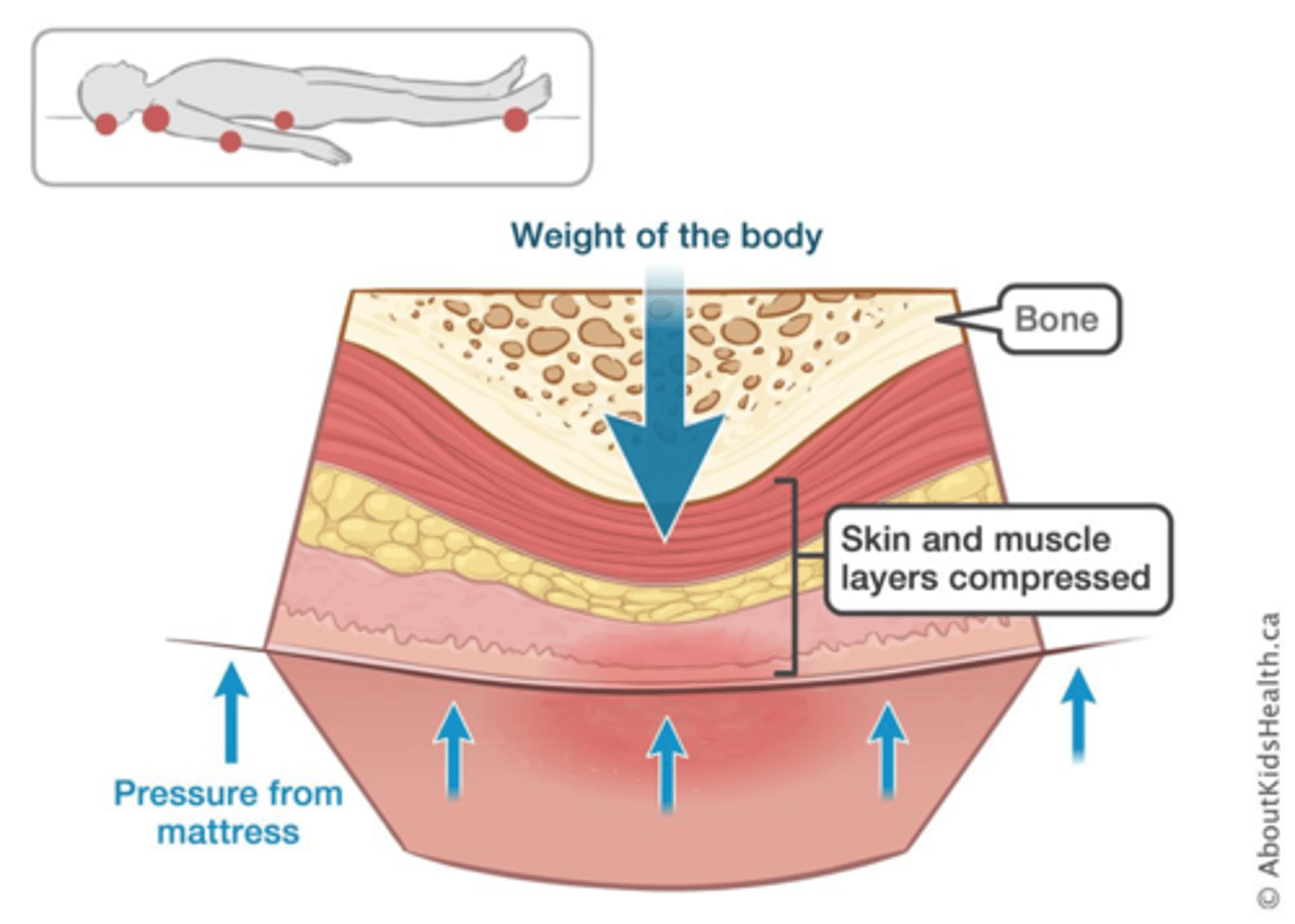 <p>Result of localized ischemia and necrosis caused by unrelieved pressure against skin over bony prominence</p>