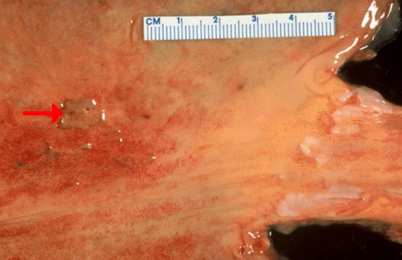 <p>Condition: Acute gastric ulcer</p><ol><li><p>Ulcer</p></li><li><p>hemorrhage, penetration (extension into an adjacent organ), perforation (communication with the peritoneal cavity), and stricture (as a result of scarring)</p></li><li><p><em>Helicobacter pylori </em>infection; NSAIDs</p></li></ol><p></p><p>An ulcer is an area of full-thickness loss of the mucosa (an erosion is a partial-thickness loss).</p>