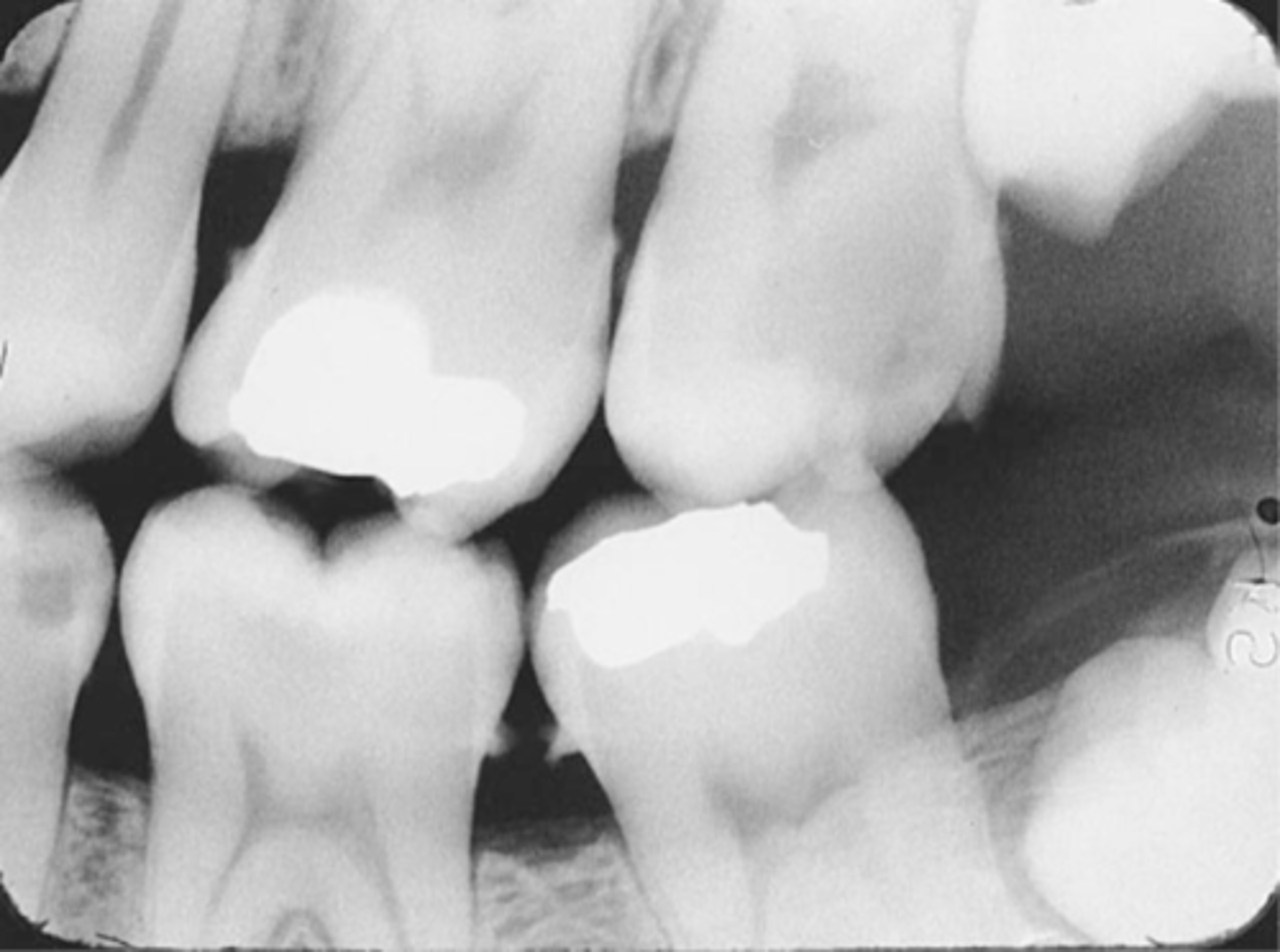 <p>-Bite-wing must be positioned so that the resluting image shows both max and mand molars, and centered over the mand 2nd molar.</p><p>-Receptor must be positioned so that the front edge of the receptor is aligned with the midline of the mand. 2nd premolar</p>