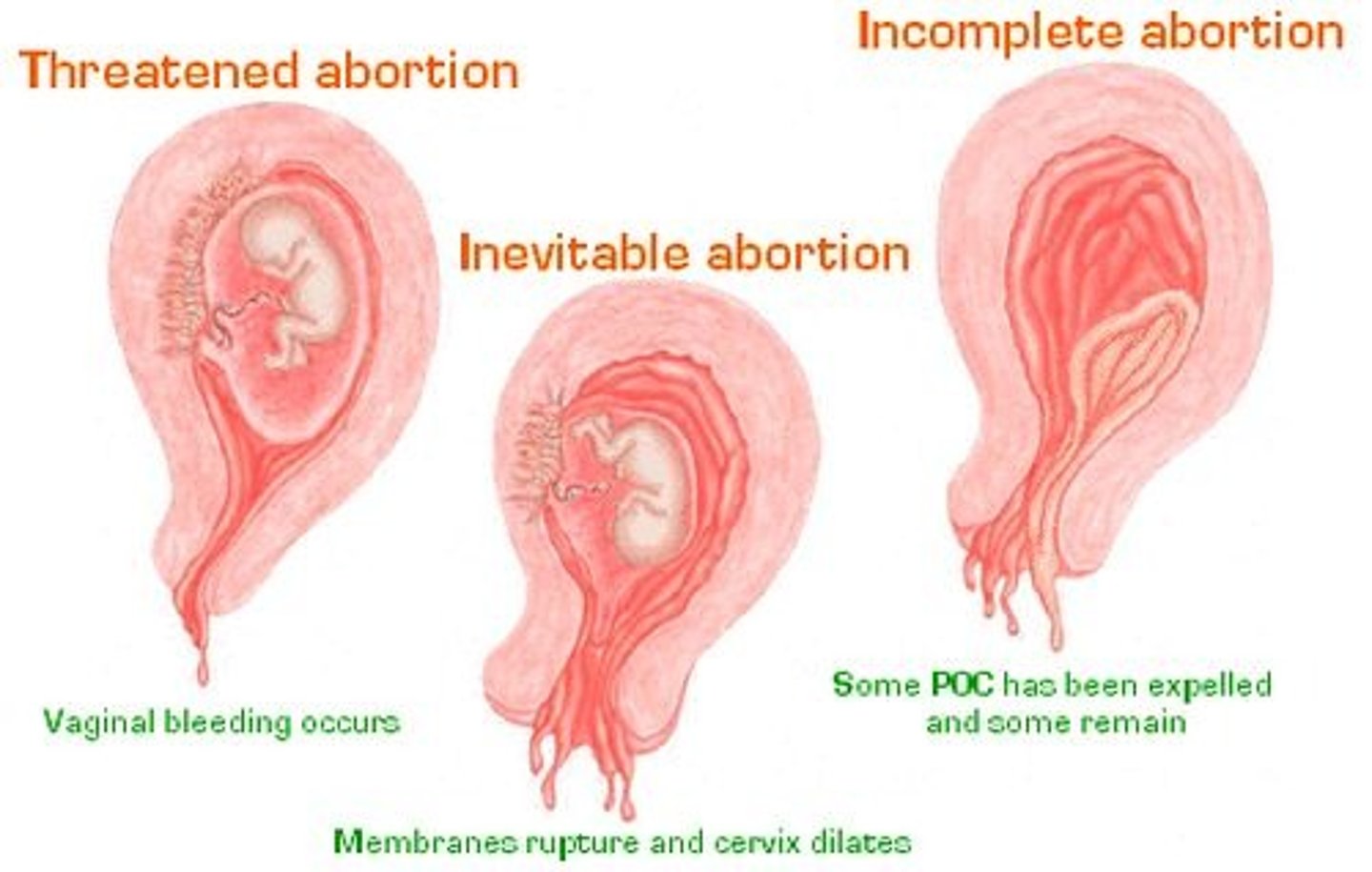 <p>Pregnancy that ends on its own prior to fetal viability (20 weeks); otherwise known as a miscarriage</p>