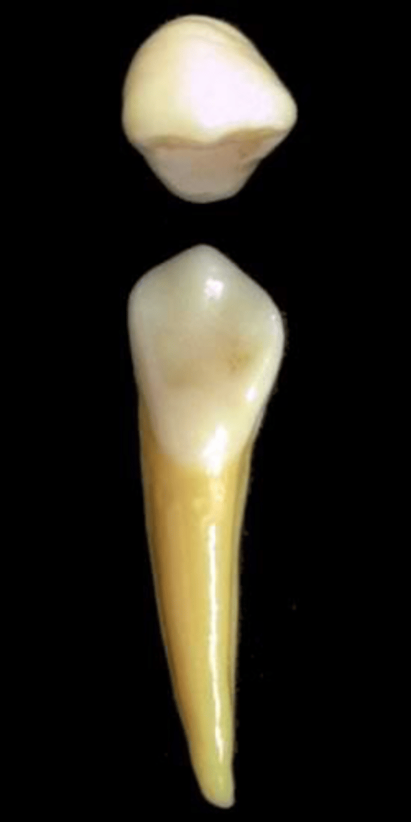 <p>what tooth is this &amp; why?</p>