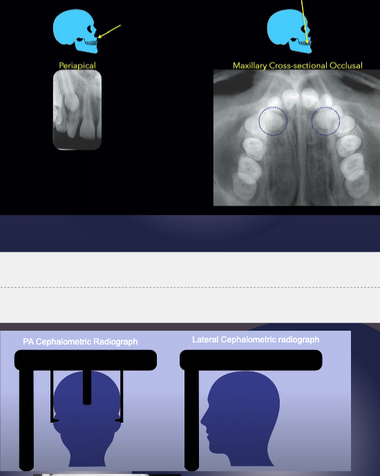<p>Obtain 2 radiographs at 90 degrees to each other of the area of interest. For example,</p><ul><li><p>periapical and occlusal radiographs</p></li><li><p>Lateral cephalometric and postero-anterior view of skull</p></li></ul><p></p>