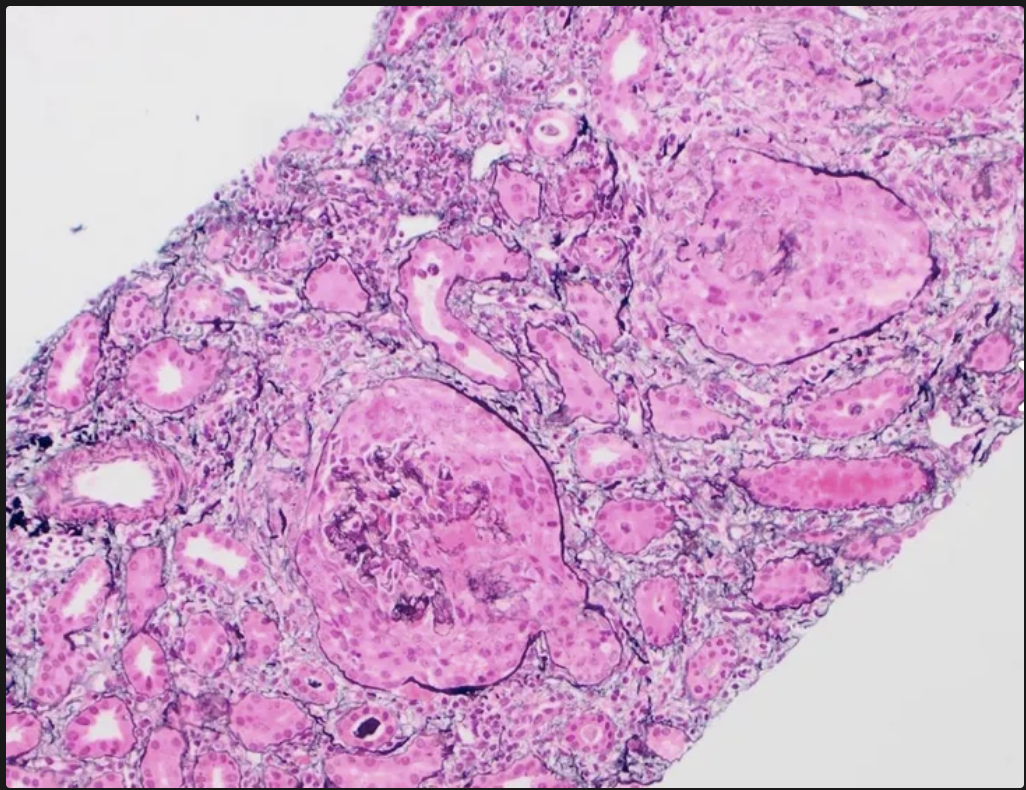 <p>La granulomatosis eosinófilica con poliangeitis (Churg-Strauss) está conformada por vasculitis de _________ y _________, pero no hay eosinófilos ni _______</p>