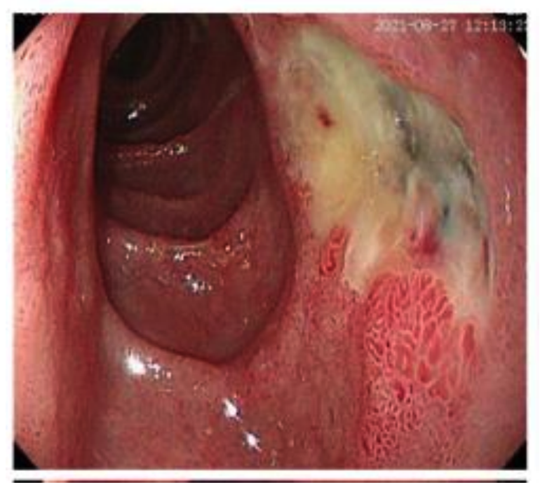 <ul><li><p>Gastric pain</p></li><li><p>Fulminant peptic ulcers</p></li><li><p>Massive gastric hypersecretion</p></li><li><p>Hypergastrinemia</p></li><li><p>Diarrhea</p></li><li><p>Steatorrhea </p></li></ul><p></p>