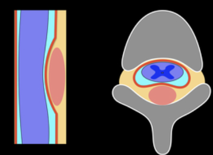 <p><strong><u>Tumor</u></strong> originating from tissues outside the <strong><u>spinal cord i</u></strong>ncluding the <strong><u>meninges, epidura tissue or vertebral </u></strong>structures </p>