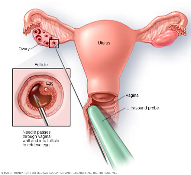 <p>The mother is given drugs that block FSH and LH to temporarily stop the menstrual cycle, so that it can be controlled using artificial hormone injections.<br><br>Large doses of LH and FSH are used to stimulate multiple follicles in the ovaries to mature, and eventually burst to release MULTIPLE mature eggs into the fallopian tube (through a process called superovulation). <br><br>The eggs are then collected through follicular aspiration and fertilized in a lab using sperm. The fertilized eggs develop into embryos, and one or more than one are implanted into the uterus; After that, the zygote should develop normally, as if it had been normally fertilized.<br></p>