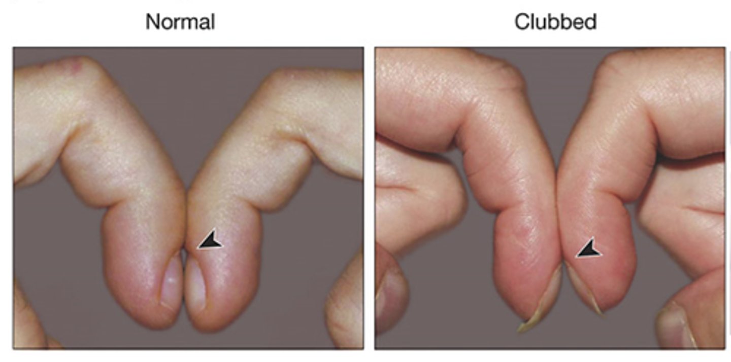 <p>instructions:</p><p>I am just going to do a quick assessment to check for nail clubbing. If you could just take both of your pointer fingers and put them together, so the tips of your nails are touching</p><p>procedure:</p><p>I am going to use the Schamroths window test to look at the patient's fingertips. I will look at the nails and make sure they have an angle to them. I will also make sure I can see light between the patient's fingertips, also known as viewing Schamroth's window.</p>