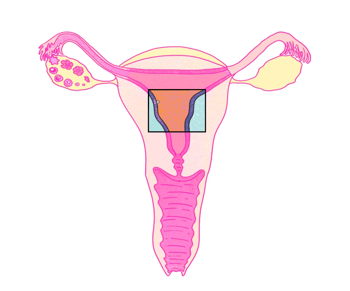 <p><strong>main area</strong> where <span style="color: blue"><strong>implantation</strong></span> ( of zygote into uterus wall ) occurs</p><img src="https://lh7-rt.googleusercontent.com/docsz/AD_4nXdye4SH2JHNpyAodtLDbOKL7i-9tCfCSEaGUu7gb2vzTa43Slrf6cToBZNVb3RIN-INZJDFXbmaZw8oZwvrbiWbE9SczDtVZpTp25eHy2tQRX-pT1pX6El8ghJ1s_AWIDOE6b71?key=0NmS09b7DSVt44FZoYhqRUdh" data-width="25%" data-align="center"><img src="https://lh7-rt.googleusercontent.com/docsz/AD_4nXdUFvEhWshnhz777yXLn1T4e6GbVXC6MLeY3xel0uZh1_IG1FB0fXlPQCDwRjAg1eSnAoae2bZAmb0LK91Uy1SCbyR5dLp-pBXPobcfWBsOpOaK46DX0tJgQQGbmieTEOeR1lug7g?key=0NmS09b7DSVt44FZoYhqRUdh" data-width="25%" data-align="center"><p></p>