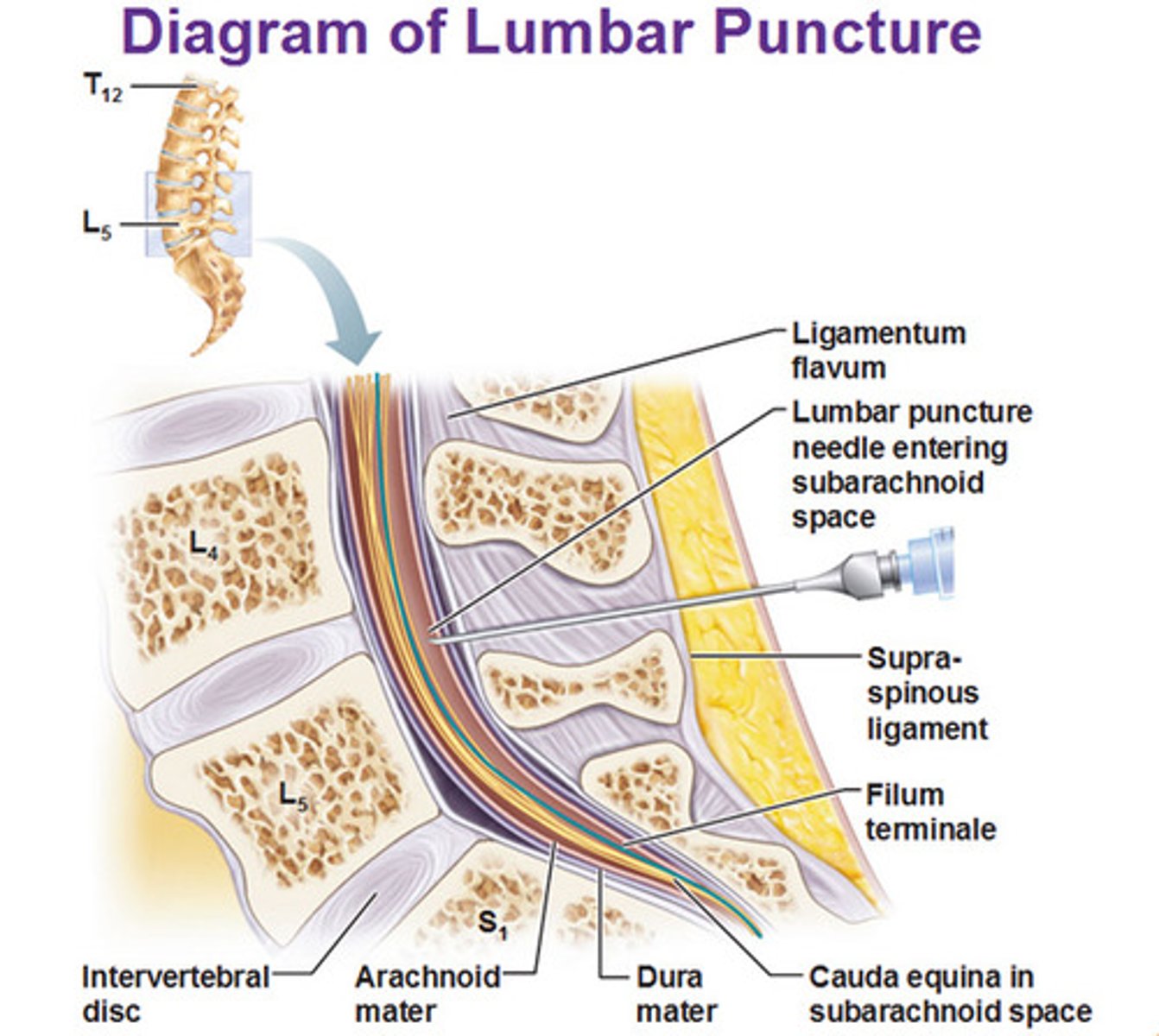 <p>Procedure performed by using a needle to withdraw CSF --fluid drawn from subarachnoid space</p>