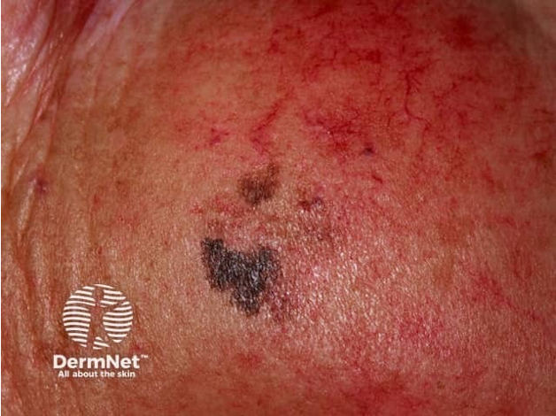 <ul><li><p>commonly arises on sun damaged areas of skin in older pts</p></li><li><p>begins as freckle like, tan or brown macule</p></li><li><p>gradually enlarges and darkens w/ asymmetric foci or pigmentation, color variegation</p></li><li><p>raised areas signify vertical growth into dermis</p></li><li><p>blurred borders w/ notch “geographic” shapes</p></li></ul><p></p>