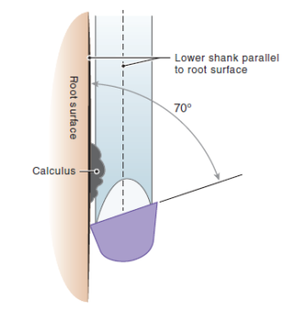<p>Area Specific Curets have a tilted face, the lower cutting edge is the one that is being used therefore called the working cutting edge. </p><ul><li><p>the non-cutting edge is angled away, protecting tissue from damage</p></li></ul><p></p>
