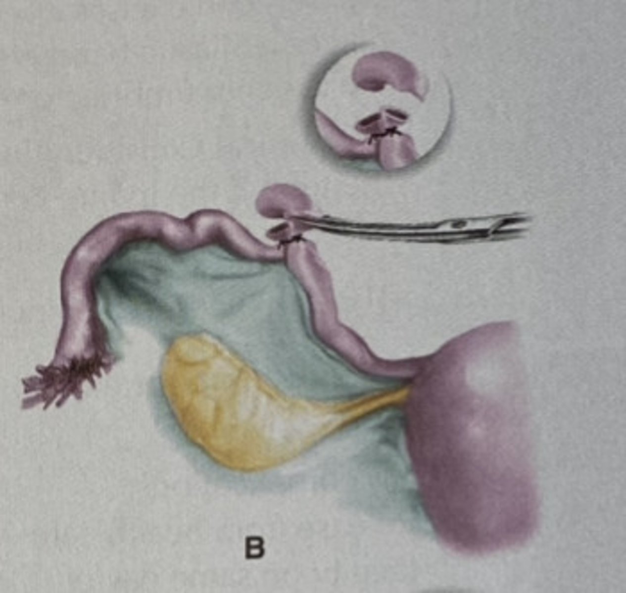 <p>Define Cause of Infertility:</p><p>-Hx:</p><p>&gt; Salpingitis (Untreated/Undertreated GC/CT/PID --&gt; Tubal scarring &amp; infertility ==&gt; Risk of Ectopic Pregnancy)</p><p>&gt; Endometriosis</p><p>&gt; Tubal Adenomyosis</p><p>&gt; Tubal Surgery</p><p>&gt; TB</p><p>-Path: Locations of Occlusion</p><p>&gt; 1st MC = Fimbrial end</p><p>&gt; 2nd MC = Mid-Segment</p><p>&gt; 3rd MC = Isthmus-cornu</p><p>-Dx: HSG or Laparoscopy w/ chromotubation</p><p>-Tx: Microsurgical tuboplasty</p><p>&gt; 60-80% pregnancy thereafter</p><p>&gt;&gt; 10% are ectopic</p><p>&gt; Hydrosalpinx reduces IVF success by 50% -- repair or remove</p>