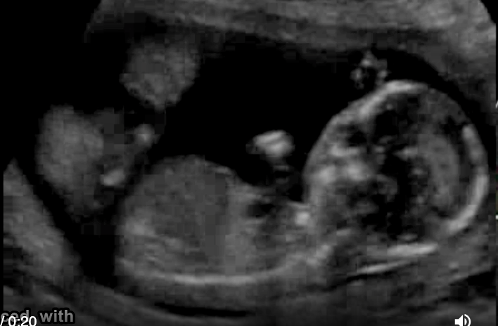 <p>a pt has recent <strong>acute onset HTN</strong>, nausea, vomit. she has no pain, cramping, or vaginal bleeding. a prior US at 6w indicates the pregnancy should now be 17w6d GA. the image shows strong suspicion of</p><p>.</p><p>video is of<strong> trophoblastic gestation/molar</strong> - most fetuses have asymmetrical large head + small body</p><p>.</p><p>a) trisomy 21</p><p>b) triploidy</p><p>c) trisomy 13</p><p>d) trisomy 18</p>