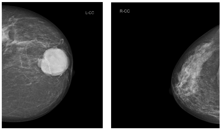 <p>What does this Mammography show?</p>