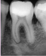 <p>no radiolucent rim, borders blend w surrounding trabeculae; is due to pulpal involvement </p>