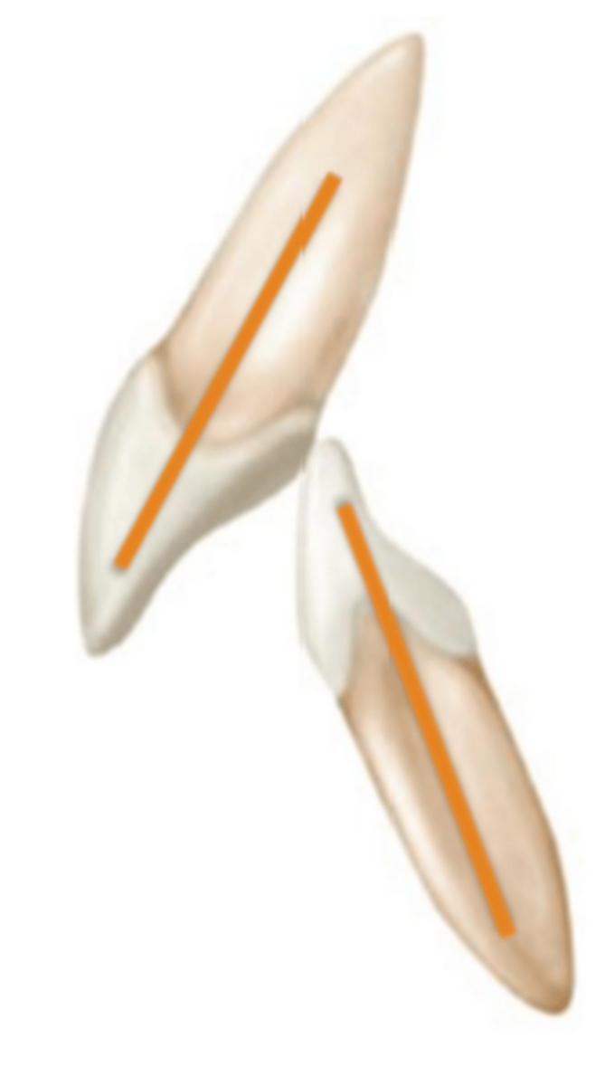 <p>A) class II molar retention w/ normal labial inclination of incisors</p>