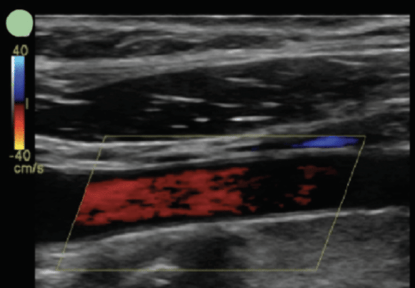 <p>Lack/absence of flow - can be mistaken for pathology</p><p>Can occur in small vessels or deeper vessels</p><p>Under-amplification of signals</p>