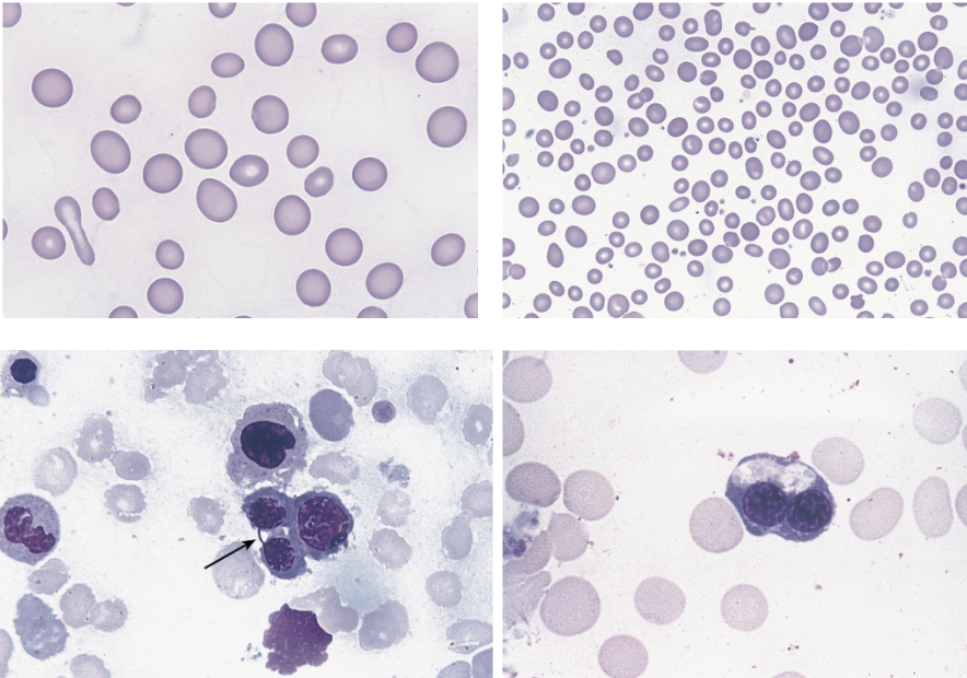 <p>these morphological abnormalities of the peripheral blood (top 2 images) and BM (bottom 2 images) are characteristic of ____.</p>
