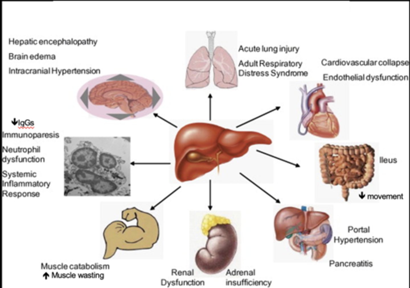 <p>Systemic Manifestations of Liver Failure</p>