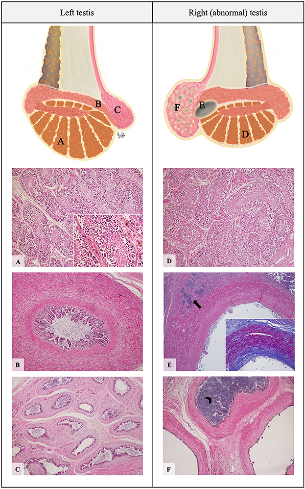 <p>Distension of the epididymis filled with sperm, usually due to a blockage</p>