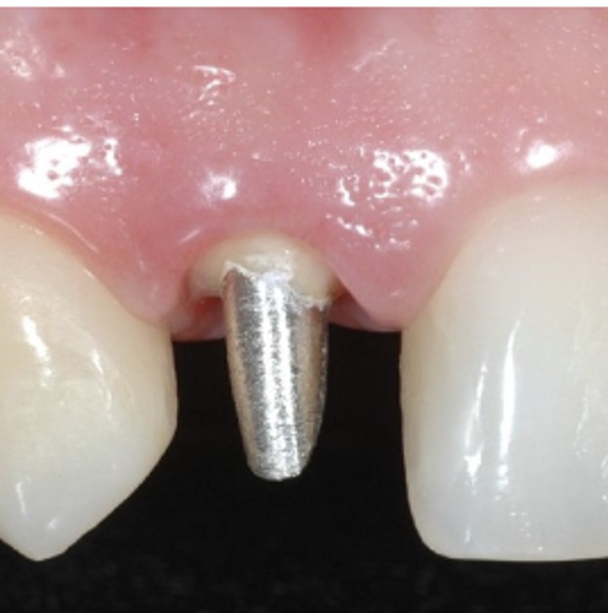<p>Tooth #7 suffers from trauma and had a root canal treatment along with a cast yellow gold post and core. Pt is 24 years old and is very much concerned with her appearance. You did an all ceramic crown for her and the crown turned out to look greyish since the yellow gold shows through your all ceramic crown. The patient is very unhappy with the outcome. Which one would be a possible next step for you?</p><p>A) You will tell the patient that nothing can be done.</p><p>B) You will place a provisional crown back and inform the patient that an alternative restorative material such as a PFM crown will be utilized. She will have 2 crowns to choose from at her next visit.</p>
