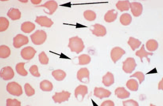 <ul><li><p>helmet cells, blister cells</p></li><li><p>appear to contain vacuole attached to side of cell</p></li><li><p>associated with hepatic disease, neoplasia, IV trauma </p></li></ul><p></p>