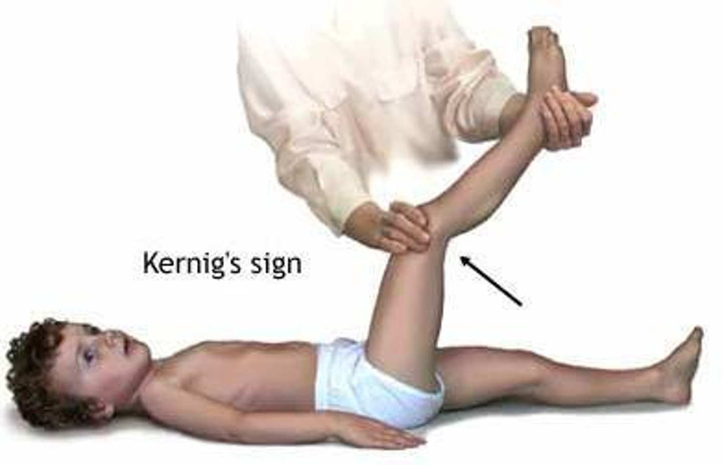 <p>+ Kernig & Brudzinski & stiff neck</p>