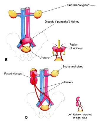 <p>Renal Ectopia:</p><ul><li><p>Simple: <span><span>one or both kidneys in an abnormal position</span></span></p><ul><li><p>Usually <span><span>more inferior than usual; failure to ascend</span></span></p></li></ul></li><li><p><span><span>discoid or pancake kidney: Pelvic kidneys may fuse to form a round mass; does not ascend</span></span></p></li><li><p><span><span>Crossed: Developing Kidneys Fused, then ascend</span></span></p></li><li><p><span><span>Consequences</span></span></p><ul><li><p><span><span>urinary tract infections, kidneys stones, kidney failure b/c of blockage or vesicouretral reflux</span></span></p></li></ul></li></ul><div data-type="horizontalRule"><hr></div><p><span><span>Malrotated: </span></span></p><ul><li><p><span><span>no rotation > face anteriorly; too far > face posteriorly; also can face laterally</span></span></p></li><li><p><span><span>Usually asymptomatic but hydronephrosis and stone formation more frequent</span></span></p></li></ul><p></p>