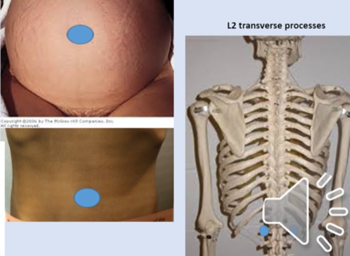 <p>anterior point: periumbilical<br>posterior point: L2 transverse process</p>