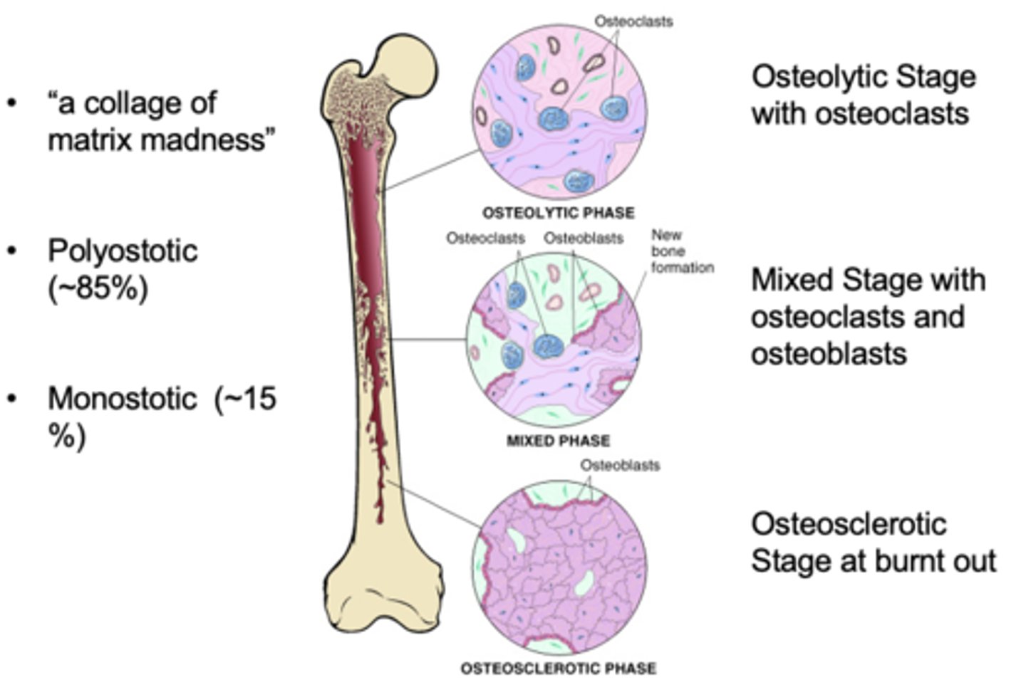 <p>mix of osteolytic and osteoblastic phases</p>
