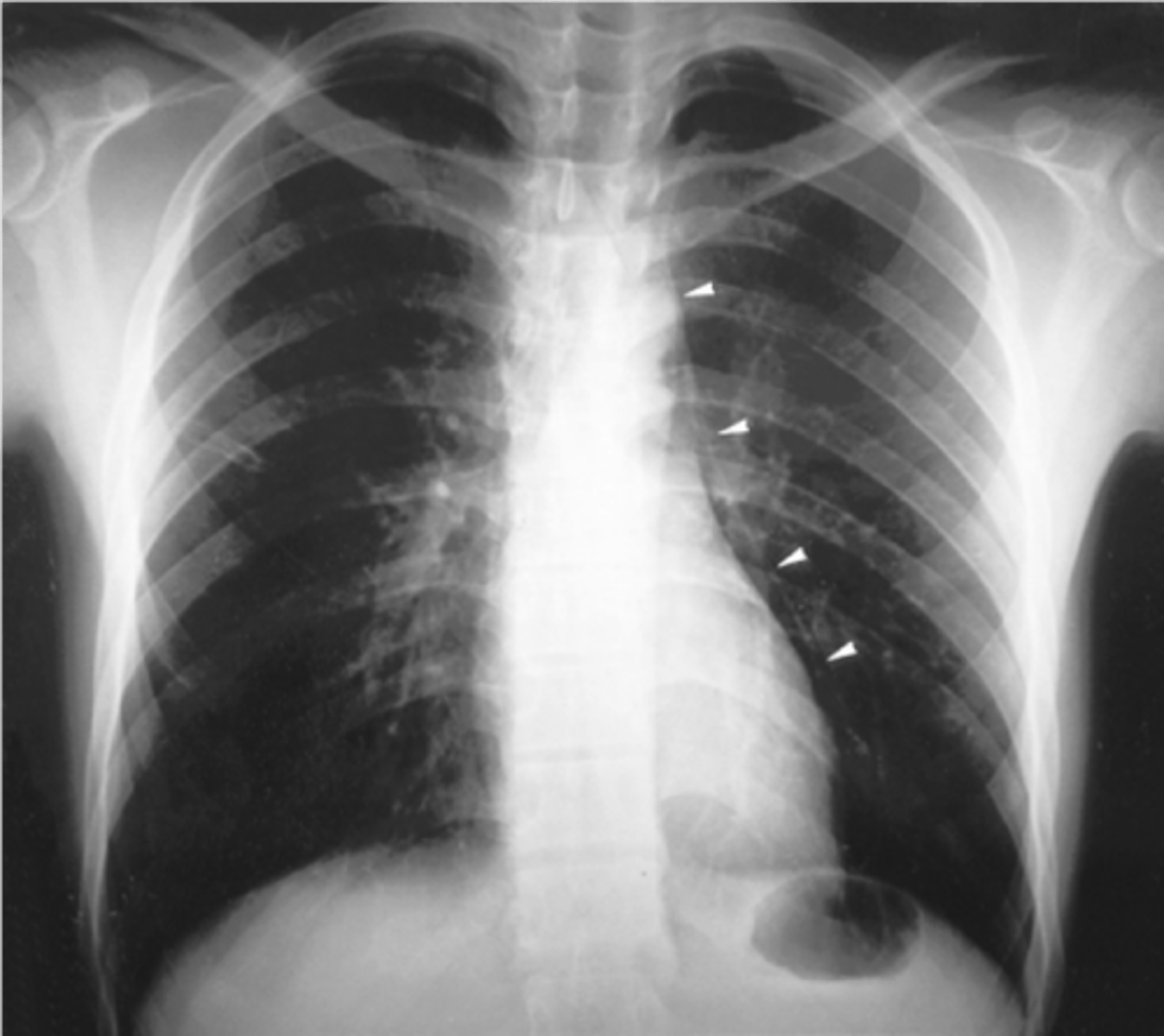 <p>Pneumomediastinum</p>