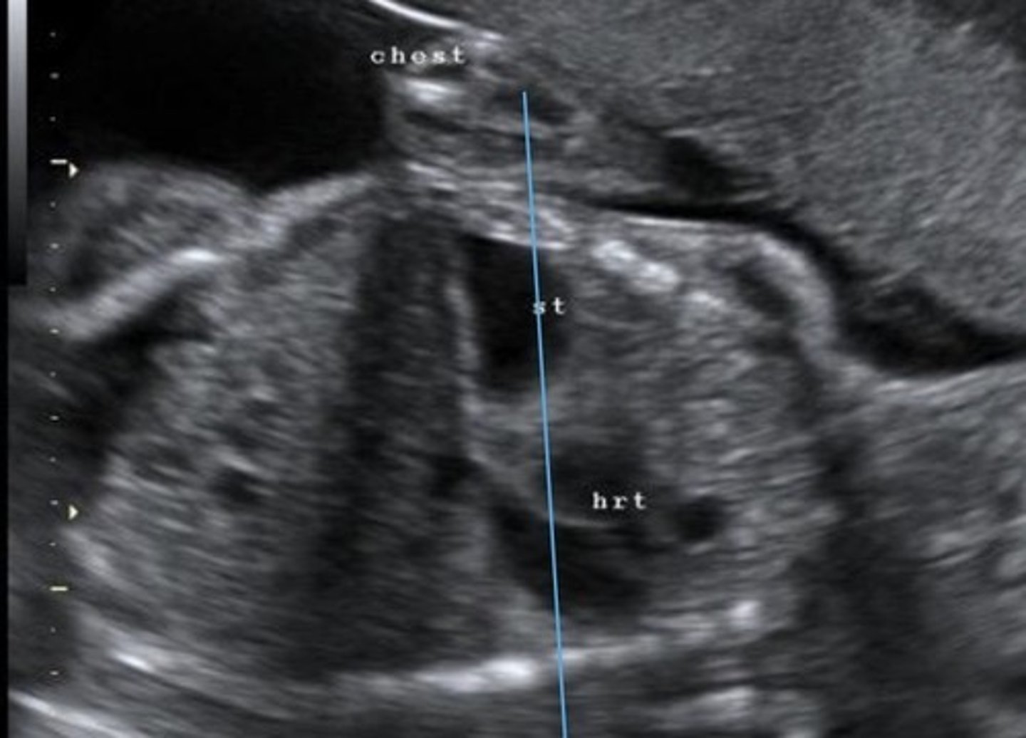 <p>Herniation of abdominal organs into thoracic cavity through defect in diaphragm</p>