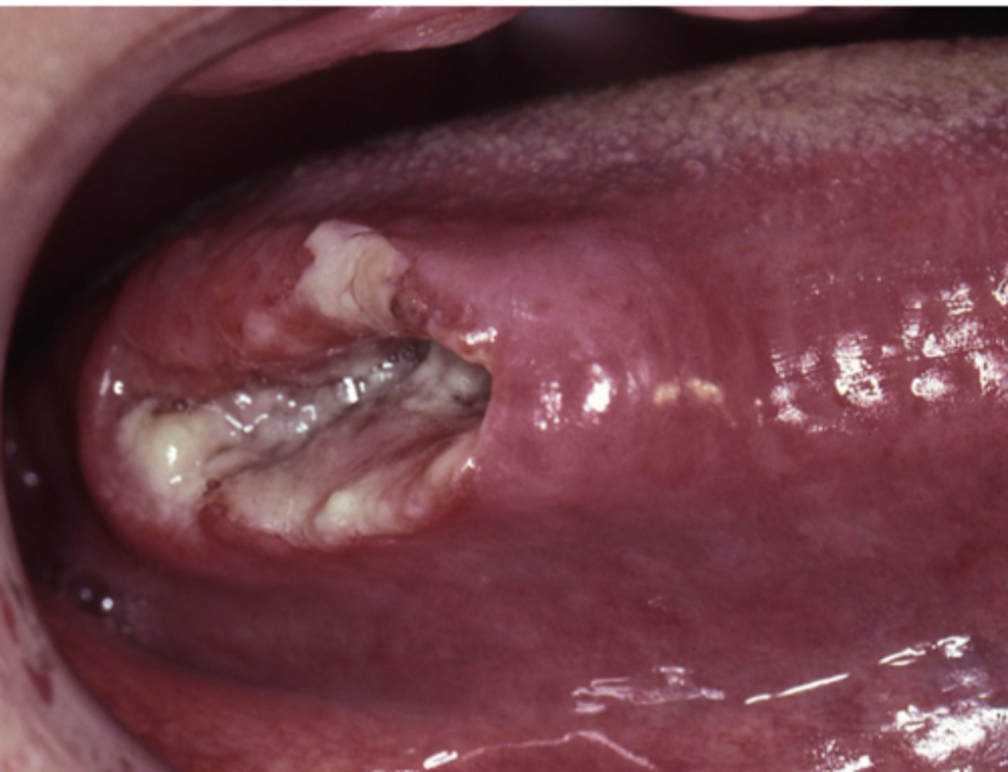 <p>Squamous cell carcinoma</p>