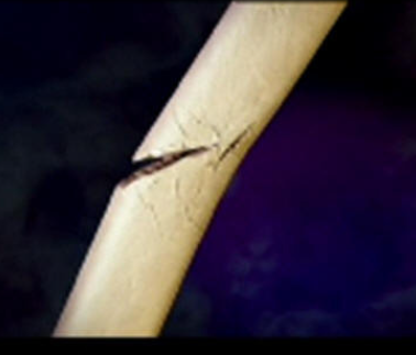 greenstick fracture