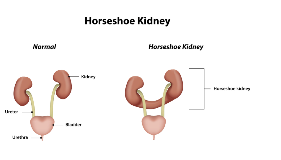 <p>A congenital abnormalitiy where the two kidneys are fused together at their lower ends, forming a "U" shape, which can affect their function and position. </p>