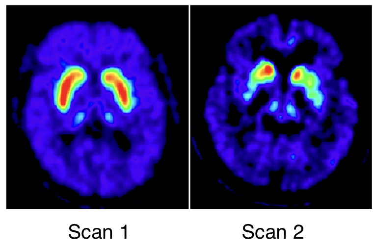 <p>Which is the healthy brain and which is the Parkinson’s brain?</p>