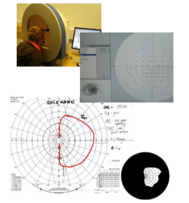 <ul><li><p>Not good at distinguishing the boundary between seeing and blind.</p></li><li><p>Patient may be influenced by sounds instead of sight.</p></li><li><p>Preferable to use formal parametric method (image)</p><ul><li><p>Present spots of light.</p></li><li><p>Use a clicker to indicate if they can see it.</p></li><li><p>Important to test eye separately</p></li></ul></li></ul><p></p>