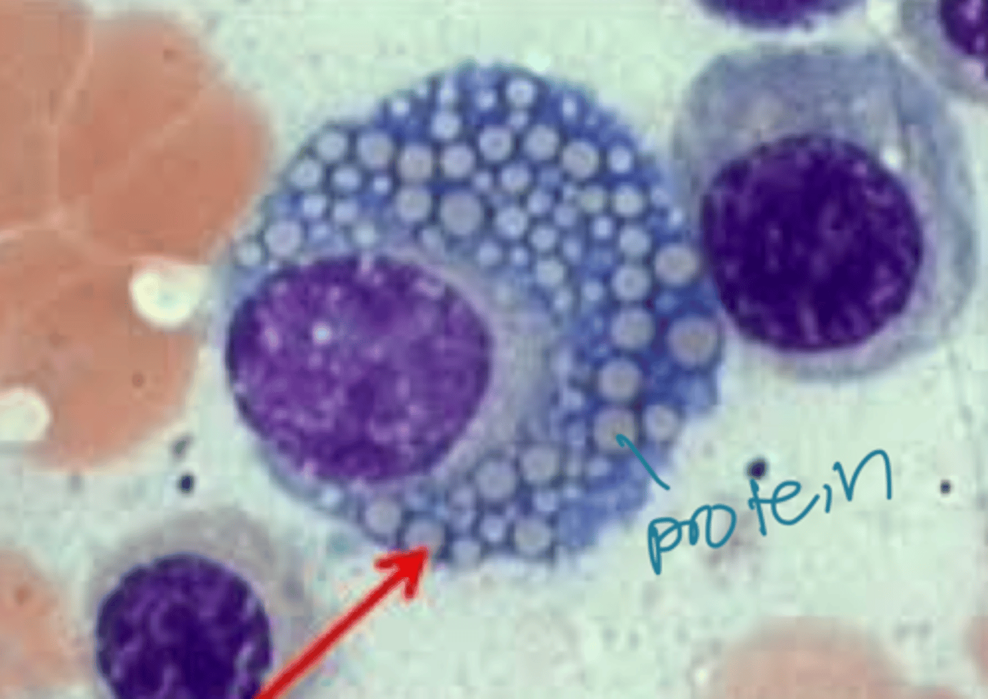 <p>- Russell bodies (immunoglobulins) in constipated plasma cells ("Mott cells")</p><p>- Reabsorption droplets in renal tubules (due to protein loss in urine)</p>