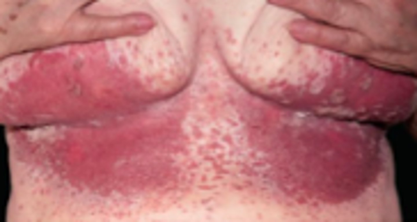 <p>Fungal ID:</p><p>Overview:</p><p>- Opportunistic infection due to Candida (fungi)</p><p> often present in healthy persons as part of normal flora, but can invade and cause disease, which will lead to signs/symptoms that affect skin, oral cavity, GI tract, vagina, penis, or other parts of the body</p><p>- Risk factors: host defense defects, obesity, DM, hyperhidrosis, warm climate, use of glucocorticoids</p>