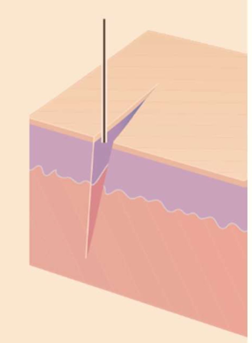 <p>¿lesión?</p><p>¿primaria o secundaria?</p>