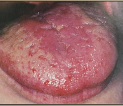 <p>candidiasis causing burning painful, red lesions after course of antibiotics </p>